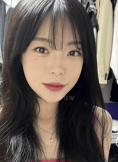 At six months after facial contouring surgery, accidents can be frightening, but healing bones are usually stable if no direct facial impact occurs.