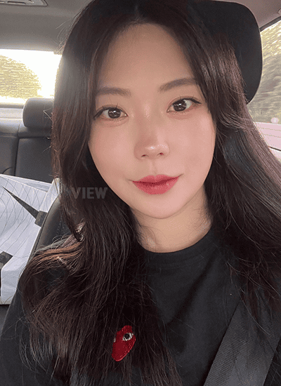 7 Months After Korean Plastic Surgery at View Plastic Surgery, Korea