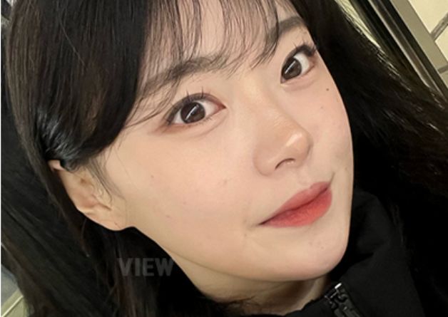 8 Months After Korean Facial Contouring Surgery at View Plastic Surgery, Korea