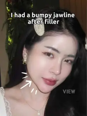 I corrected my bumpy jawline with facial contouring ✨ Copyrights to images and all other materials related to this content belong to VIEW and you may be liable for unauthorized distribution and or reproduction of the same without written consent. #korea #chaeryeong #makeup #katyperry #filler