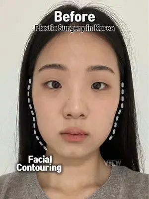 Total glow up with facial contouring, rhinoplasty & double eyelid surgery in Korea Copyrights to images and all other materials related to this content belong to VIEW and you may be liable for unauthorized distribution and or reproduction of the same without written consent. #korea #chaeryeong #plasticsurgery #karina #facialcontouring