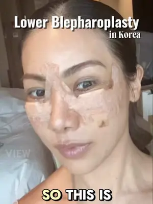 Blepharoplasty in Korea Copyrights to images and all other materials related to this content belong to VIEW and you may be liable for unauthorized distribution and or reproduction of the same without written consent. #korea #kbeauty #blepharoplasty #annehathaway #seoul
