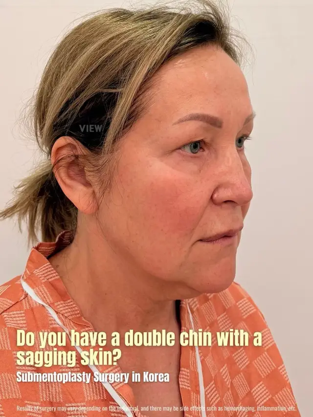 Copyrights to images and all other materials related to this content belong to VIEW and you may be liable for unauthorized distribution and or reproduction of the same without written consent. #korea #facelift #krisjenner #annehathaway #seoul