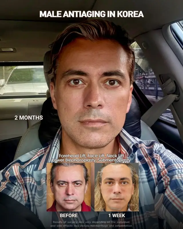 Because timeless youth and natural-looking results are for everyone Further info, contact us on whatsapp : 🇺🇸 English : +82 10 2103 7174 🇮🇩 Bahasa Indonesia : +82 10 3936 7164 Copyrights to images and all other materials related to this content belong to View Plastic Surgery and you may be liable for unauthorized distribution and/or reproduction of the same without written consent. Results of surgery may vary depending on the individual, and there may be side effects such as haemorrhaging, inflammation, etc. #korea #glowup #malesurgery #antiaging #facelift