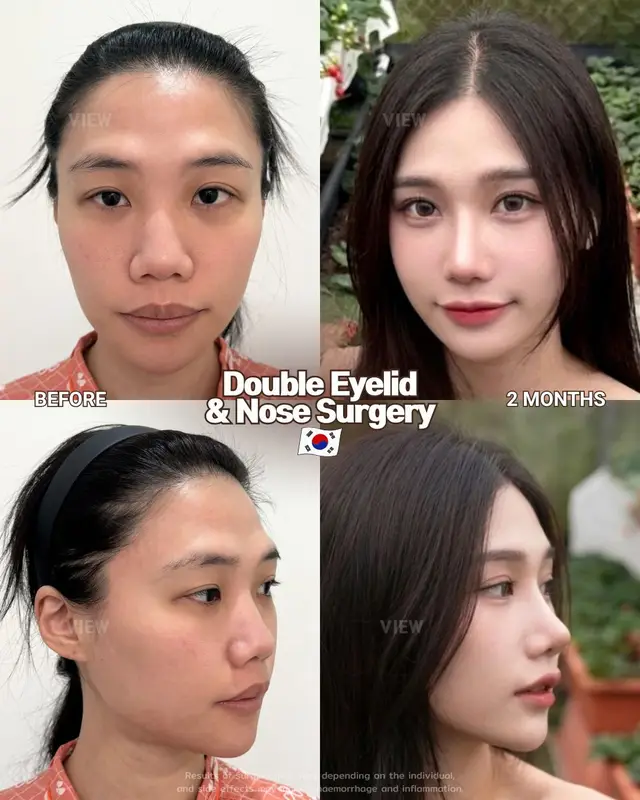 For next-level glow-ups, trust the experts at VIEW 🤍 Further info, contact us on whatsapp : 🇺🇸 English : +82 10 2103 7174 🇮🇩 Bahasa Indonesia : +82 10 3936 7164 Copyrights to images and all other materials related to this content belong to View Plastic Surgery and you may be liable for unauthorized distribution and/or reproduction of the same without written consent. Results of surgery may vary depending on the individual, and there may be side effects such as haemorrhaging, inflammation, etc. #korea #plasticsurgery #nosesurgery #rhinoplasty #eyesurgery