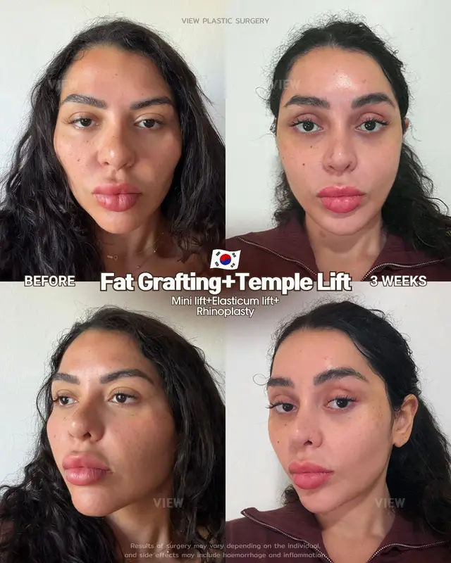 A carefully customized combination procedure designed for an effortlessly snatched look 👀 Further info, contact us on whatsapp : 🇺🇸 English : +82 10 2103 7174 🇮🇩 Bahasa Indonesia : +82 10 3936 7164 Copyrights to images and all other materials related to this content belong to View Plastic Surgery and you may be liable for unauthorized distribution and/or reproduction of the same without written consent. Results of surgery may vary depending on the individual, and there may be side effects such as haemorrhaging, inflammation, etc. #korea #glowup #plasticsurgery #fatgrafting #templelift