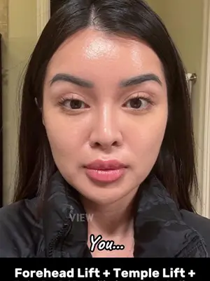Forehead Lift together with a Temple Lift? ✨ Now that's a glow-up move 🤍 🇺🇸 English: +82 10 2103 7174 🇮🇩 Bahasa Indonesia : +82 10 3936 7164 Copyrights to images and all other materials related to this content belong to View Plastic Surgery, and you may be liable for unauthorised distribution and/or reproduction of the same without written consent. Results of surgery may vary depending on the individual, and side effects may include haemorrhage and inflammation. #plasticsurgery #koreaplasticsurgery #seoul #korea #facelift