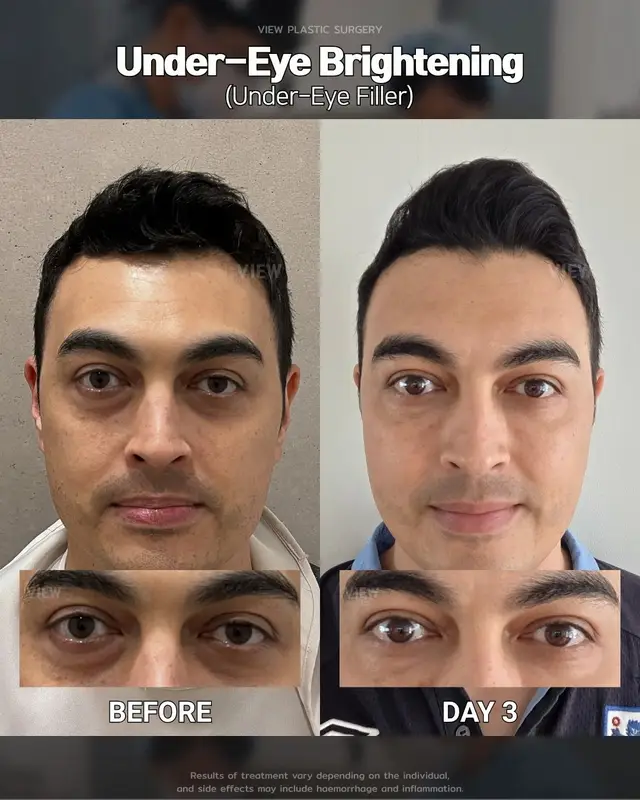 Under-Eye Filler for instant rejuvenation 👀🤍 Look fresh with VIEW Dermatology Further info, contact us on whatsapp : 🇺🇸 English : +82 10 2103 7174 🇮🇩 Bahasa Indonesia : +82 10 3936 7164 Copyrights to images and all other materials related to this content belong to View Plastic Surgery and you may be liable for unauthorized distribution and/or reproduction of the same without written consent. Results of treatment may vary depending on the individual, and there may be side effects such as haemorrhaging, inflammation, etc. #korea #dermatology #skincare #skinbrightening #glowup