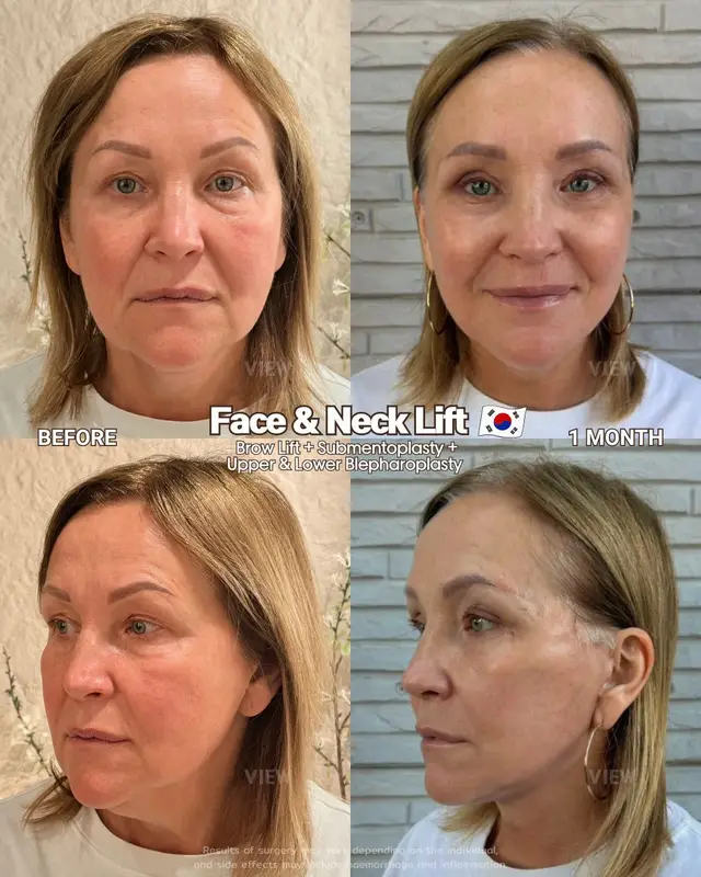 Turns out, time travel is possible with VIEW 😉🤍 Every anti-aging plan is carefully customized to each patient’s unique features, concerns, and goals. Further info, contact us on whatsapp : 🇺🇸 English : +82 10 2103 7174 🇮🇩 Bahasa Indonesia : +82 10 3936 7164 Copyrights to images and all other materials related to this content belong to View Plastic Surgery and you may be liable for unauthorized distribution and/or reproduction of the same without written consent. Results of surgery may vary depending on the individual, and there may be side effects such as haemorrhaging, inflammation, etc. #korea #glowup #plasticsurgery #antiaging #facelift