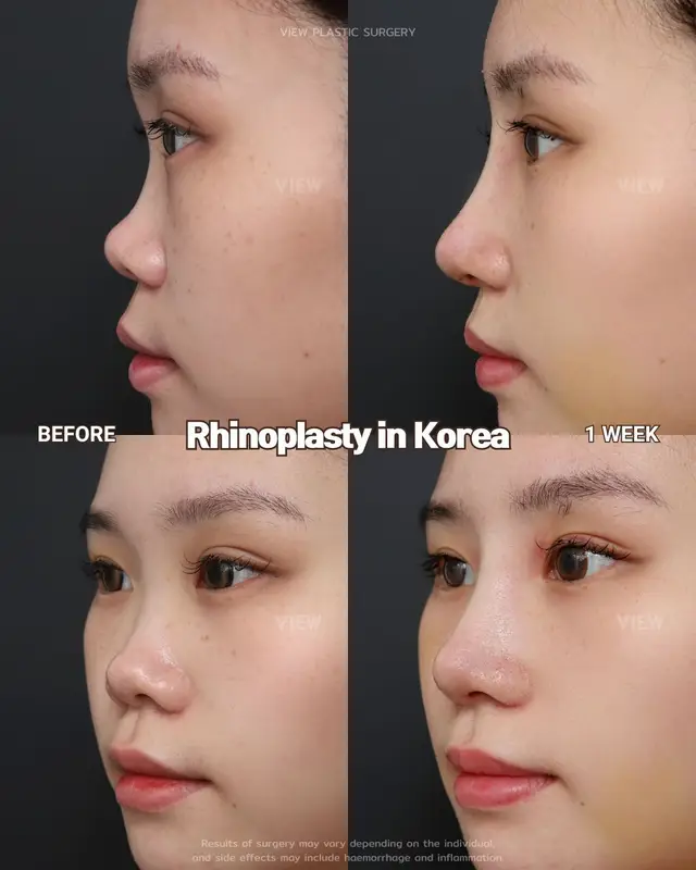 What a transformation 👀 See what’s possible with VIEW 🤍 Further info, contact us on whatsapp : 🇺🇸 English : +82 10 2103 7174 🇮🇩 Bahasa Indonesia : +82 10 3936 7164 Copyrights to images and all other materials related to this content belong to View Plastic Surgery and you may be liable for unauthorized distribution and/or reproduction of the same without written consent. Results of surgery may vary depending on the individual, and there may be side effects such as haemorrhaging, inflammation, etc. #korea #kbeauty #kpop #nosesurgery #rhinoplasty