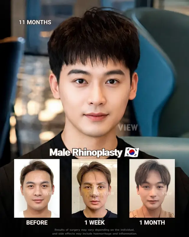 Because confidence and beauty are for everyone 🤍 Further info, contact us on whatsapp : 🇺🇸 English : +82 10 2103 7174 🇮🇩 Bahasa Indonesia : +82 10 3936 7164 Copyrights to images and all other materials related to this content belong to View Plastic Surgery and you may be liable for unauthorized distribution and/or reproduction of the same without written consent. Results of surgery may vary depending on the individual, and there may be side effects such as haemorrhaging, inflammation, etc. #korea #kbeauty #kpop #nosejob #rhinoplasty
