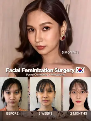 The difference is in the details ✨ Subtle refinements can completely transform your overall appearance 🤍 Discover VIEW’s Facial Feminization Surgery Further info, contact us on whatsapp : 🇺🇸 English : +82 10 2103 7174 🇮🇩 Bahasa Indonesia : +82 10 3936 7164 Copyrights to images and all other materials related to this content belong to View Plastic Surgery and you may be liable for unauthorized distribution and/or reproduction of the same without written consent. Results of surgery may vary depending on the individual, and there may be side effects such as haemorrhaging, inflammation, etc. #korea #kbeauty #kpop #feminization #plasticsurgery