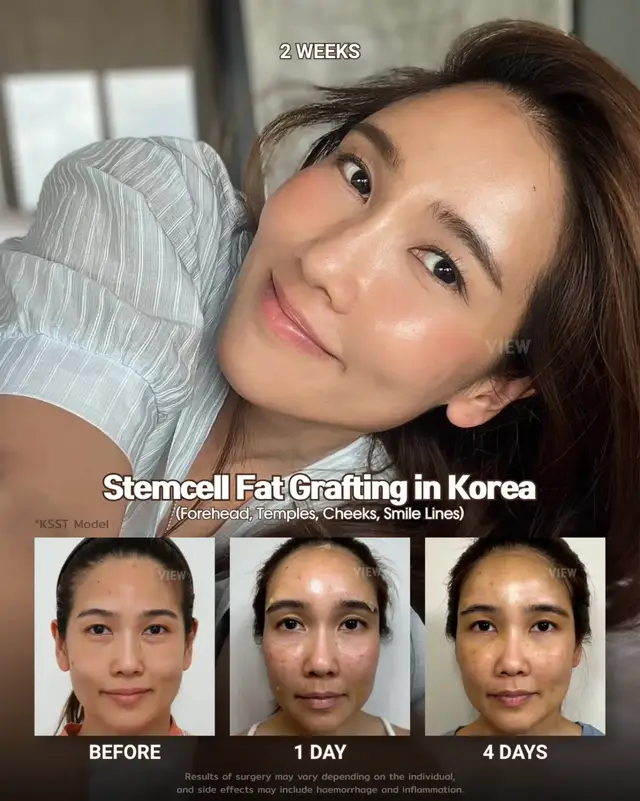 Level up your look with Stemcell Fat Grafting 🤍 Further info, contact us on whatsapp : 🇺🇸 English : +82 10 2103 7174 🇮🇩 Bahasa Indonesia : +82 10 3936 7164 Copyrights to images and all other materials related to this content belong to View Plastic Surgery and you may be liable for unauthorized distribution and/or reproduction of the same without written consent. Results of surgery may vary depending on the individual, and there may be side effects such as haemorrhaging, inflammation, etc. #korea #kbeauty #kpop #stemcell #plasticsurgery