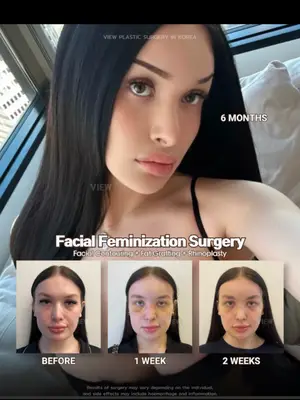 Softening features, enhancing harmony, and creating a look that feels truly you ✨ Feminization surgery is all about balance and confidence 🤍 Further info, contact us on whatsapp : 🇺🇸 English : +82 10 2103 7174 🇮🇩 Bahasa Indonesia : +82 10 3936 7164 Copyrights to images and all other materials related to this content belong to View Plastic Surgery and you may be liable for unauthorized distribution and/or reproduction of the same without written consent. Results of surgery may vary depending on the individual, and there may be side effects such as haemorrhaging, inflammation, etc. #korea #kbeauty #kpop #feminization #plasticsurgery