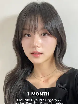 Say goodbye to tired-looking eyes 👋 Under Eye Fat Repositioning can help restore a fresher appearance 💫 Further info, contact us on whatsapp : 🇺🇸 English : +82 10 2103 7174 🇮🇩 Bahasa Indonesia : +82 10 3936 7164 Copyrights to images and all other materials related to this content belong to View Plastic Surgery and you may be liable for unauthorized distribution and/or reproduction of the same without written consent. Results of surgery may vary depending on the individual, and there may be side effects such as haemorrhaging, inflammation, etc. #korea #kbeauty #kpop #glowup #plasticsurgery