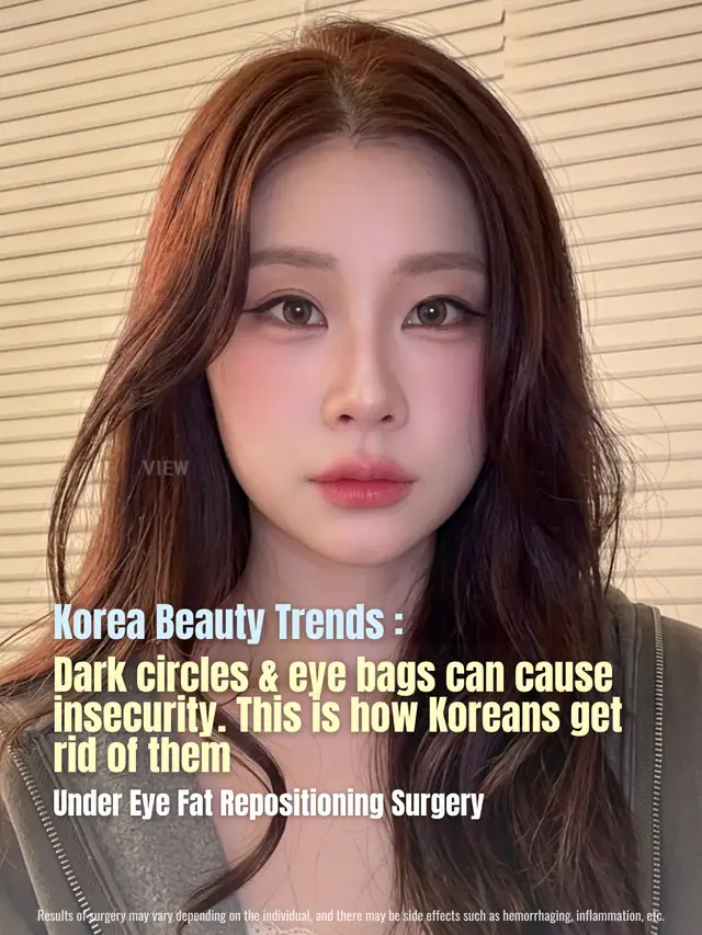 Under Eye Fat Repositioning could be the solution ✨ Further info, contact us on whatsapp : 🇺🇸 English : +82 10 2103 7174 🇮🇩 Bahasa Indonesia : +82 10 3936 7164 Copyrights to images and all other materials related to this content belong to View Plastic Surgery and you may be liable for unauthorized distribution and/or reproduction of the same without written consent. Results of surgery may vary depending on the individual, and there may be side effects such as haemorrhaging, inflammation, etc. #korea #kbeauty #kpop #glowup #plasticsurgery