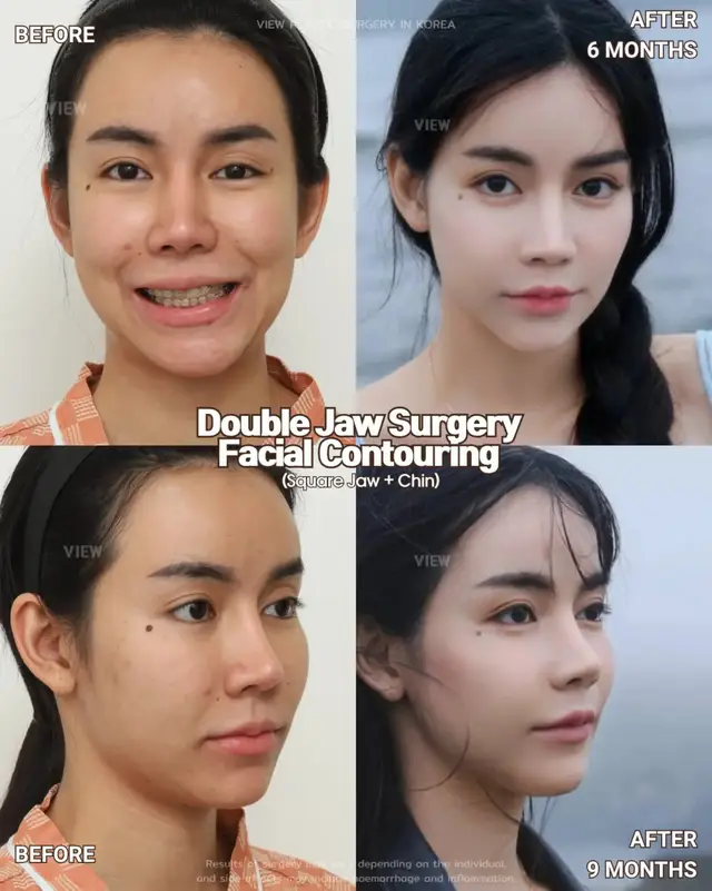 A comprehensive treatment system combining both plastic surgery and dental care 🏥🦷 From jaw surgery and facial contouring to orthodontic treatment, every step of your journey is seamlessly managed at VIEW for a safer, more precise, and more convenient experience 🤍 Further info, contact us on whatsapp : 🇺🇸 English : +82 10 2103 7174 🇮🇩 Bahasa Indonesia : +82 10 3936 7164 Copyrights to images and all other materials related to this content belong to View Plastic Surgery and you may be liable for unauthorized distribution and/or reproduction of the same without written consent. Results of surgery may vary depending on the individual, and there may be side effects such as haemorrhaging, inflammation, etc. #korea #glowup #plasticsurgery #facialcontouring #jawsurgery