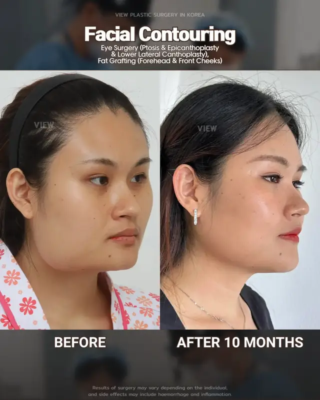 Further info, contact us on whatsapp : 🇺🇸 English : +82 10 2103 7174 🇮🇩 Bahasa Indonesia : +82 10 3936 7164 Copyrights to images and all other materials related to this content belong to View Plastic Surgery and you may be liable for unauthorized distribution and/or reproduction of the same without written consent. Results of surgery may vary depending on the individual, and there may be side effects such as haemorrhaging, inflammation, etc. #korea #glowup #plasticsurgery #facialcontouring #beauty