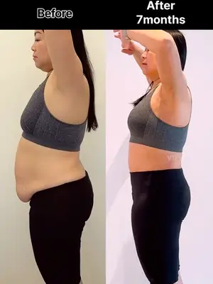 Motherhood changed her life, now it’s her turn to feel like herself again ✨ A personalized Mommy Makeover combining confidence, comfort, and natural beauty 🤍 Further info, contact us on whatsapp : 🇺🇸 English : +82 10 2103 7174 🇮🇩 Bahasa Indonesia : +82 10 3936 7164 Copyrights to images and all other materials related to this content belong to View Plastic Surgery and you may be liable for unauthorized distribution and/or reproduction of the same without written consent. Results of surgery may vary depending on the individual, and there may be side effects such as haemorrhaging, inflammation, etc. #korea #plasticsurgery #mothersday #mommymakeover #bodycontouring