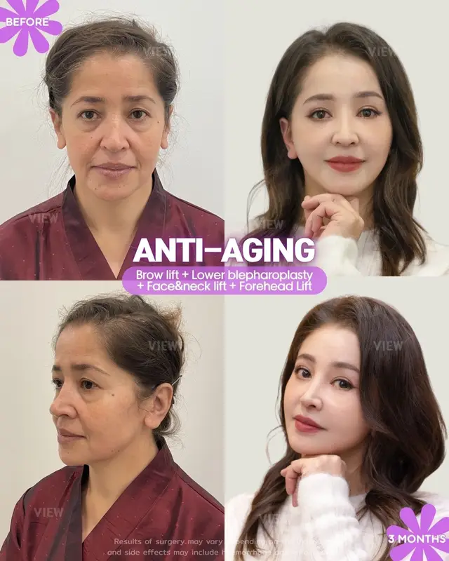 Further info, contact us on whatsapp : 🇺🇸 English : +82 10 2103 7174 🇮🇩 Bahasa Indonesia : +82 10 3936 7164 Copyrights to images and all other materials related to this content belong to View Plastic Surgery and you may be liable for unauthorized distribution and/or reproduction of the same without written consent. Results of surgery may vary depending on the individual, and there may be side effects such as haemorrhaging, inflammation, etc. #korea #glowup #plasticsurgery #antiaging #beauty
