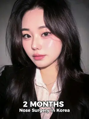 Subtle change, big difference… VIEW really did that✨ Further info, contact us on whatsapp : 🇺🇸 English : +82 10 2103 7174 🇮🇩 Bahasa Indonesia : +82 10 3936 7164 Copyrights to images and all other materials related to this content belong to View Plastic Surgery and you may be liable for unauthorized distribution and/or reproduction of the same without written consent. Results of surgery may vary depending on the individual, and there may be side effects such as haemorrhaging, inflammation, etc. #korea #glowup #plasticsurgery #nosesurgery #rhinoplasty