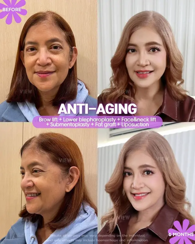 At VIEW, we bring you back to your natural beauty 🌷 Further info, contact us on whatsapp : 🇺🇸 English : +82 10 2103 7174 🇮🇩 Bahasa Indonesia : +82 10 3936 7164 Copyrights to images and all other materials related to this content belong to View Plastic Surgery and you may be liable for unauthorized distribution and/or reproduction of the same without written consent. Results of surgery may vary depending on the individual, and there may be side effects such as haemorrhaging, inflammation, etc. #korea #glowup #plasticsurgery #antiaging #beauty