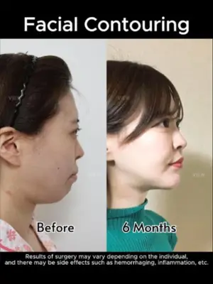 Facial contouring is more than change, it’s refined balance, tailored to you. VIEW is where precision meets artistry ✨ Further info, contact us on whatsapp : 🇺🇸 English : +82 10 2103 7174 🇮🇩 Bahasa Indonesia : +82 10 3936 7164 Copyrights to images and all other materials related to this content belong to View Plastic Surgery and you may be liable for unauthorized distribution and/or reproduction of the same without written consent. This model is exclusively for use only on View Plastic Surgery channel, and any unauthorized use is prohibited. Results of surgery may vary depending on the individual, and there may be side effects such as haemorrhaging, inflammation, etc. #korea #glowup #plasticsurgery #facialcontouring #beauty