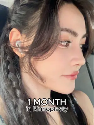 Soft changes. Sharp impact ✨ Rhinoplasty isn’t about changing your face. It’s about bringing everything into harmony 👀 VIEW just gets it 💎 Further info, contact us on whatsapp : 🇺🇸 English : +82 10 2103 7174 🇮🇩 Bahasa Indonesia : +82 10 3936 7164 Copyrights to images and all other materials related to this content belong to View Plastic Surgery and you may be liable for unauthorized distribution and/or reproduction of the same without written consent. Results of surgery may vary depending on the individual, and there may be side effects such as haemorrhaging, inflammation, etc. #korea #glowup #plasticsurgery #nosesurgery #rhinoplasty