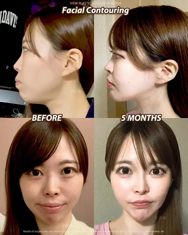 Facial contouring hits different when everything just flows A bit more definition, a lot more confidence This is what harmony looks like 💜 Further info, contact us on whatsapp : 🇺🇸 English : +82 10 2103 7174 🇮🇩 Bahasa Indonesia : +82 10 3936 7164 Copyrights to images and all other materials related to this content belong to View Plastic Surgery and you may be liable for unauthorized distribution and/or reproduction of the same without written consent. This model is exclusively for use only on View Plastic Surgery channel, and any unauthorized use is prohibited. Results of surgery may vary depending on the individual, and there may be side effects such as haemorrhaging, inflammation, etc. #korea #glowup #plasticsurgery #facialcontouring #beauty
