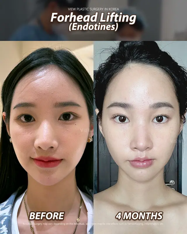A subtle lift that softens the upper face and brings natural harmony to your features. It’s that refined look that doesn’t scream for attention… but still gets it 👀💎 Further info, contact us on whatsapp : 🇺🇸 English : +82 10 2103 7174 🇮🇩 Bahasa Indonesia : +82 10 3936 7164 Copyrights to images and all other materials related to this content belong to View Plastic Surgery and you may be liable for unauthorized distribution and/or reproduction of the same without written consent. Results of surgery may vary depending on the individual, and there may be side effects such as haemorrhaging, inflammation, etc. #korea #plasticsurgery #facelifting #foreheadlifting
