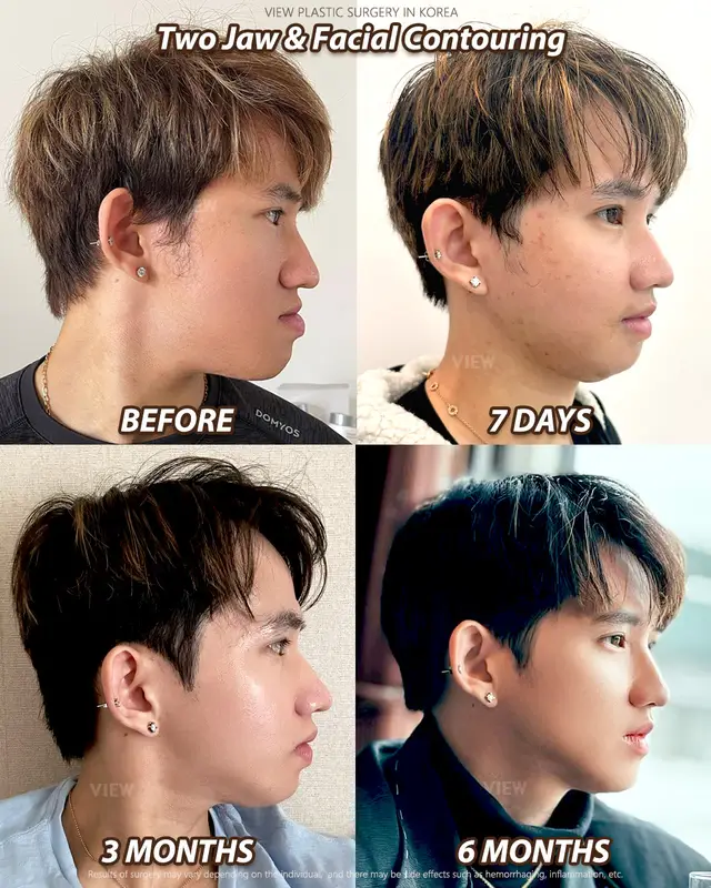 Copyrights to images and all other materials related to this content belong to View Plastic Surgery and you may be liable for unauthorized distribution and/or reproduction of the same without written consent. Results of surgery may vary depending on the individual, and there may be side effects such as haemorrhaging, inflammation, etc. #korea #glowup #kbeauty #aesthetic #jawlinesurgery