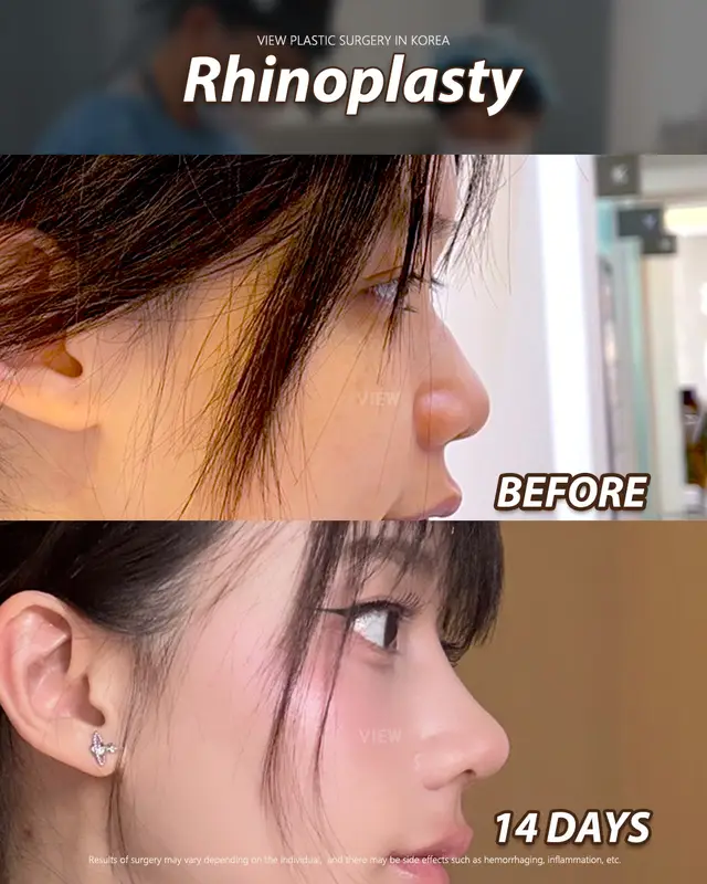 Copyrights to images and all other materials related to this content belong to View Plastic Surgery and you may be liable for unauthorized distribution and/or reproduction of the same without written consent. Results of surgery may vary depending on the individual, and there may be side effects such as haemorrhaging, inflammation, etc. #korea #glowup #plasticsurgery #nosesurgery #rhinoplasty