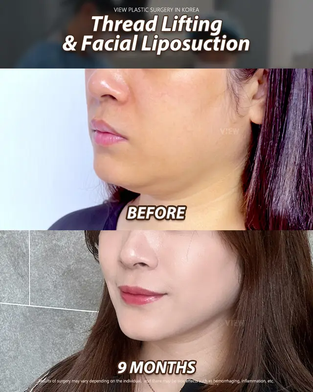 Copyrights to images and all other materials related to this content belong to View Plastic Surgery and you may be liable for unauthorized distribution and/or reproduction of the same without written consent. Results of surgery may vary depending on the individual, and there may be side effects such as haemorrhaging, inflammation, etc. #seoul #glowup #beauty #facelift #aesthetic