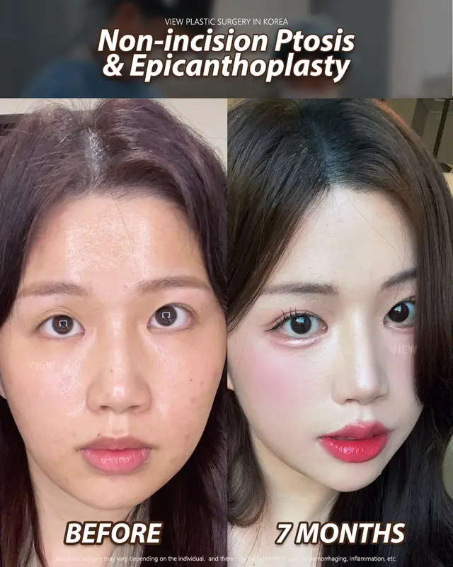 Copyrights to images and all other materials related to this content belong to View Plastic Surgery and you may be liable for unauthorized distribution and/or reproduction of the same without written consent. Results of surgery may vary depending on the individual, and there may be side effects such as haemorrhaging, inflammation, etc. #korea #kplasticsurgery #glowup #kbeauty #seoul