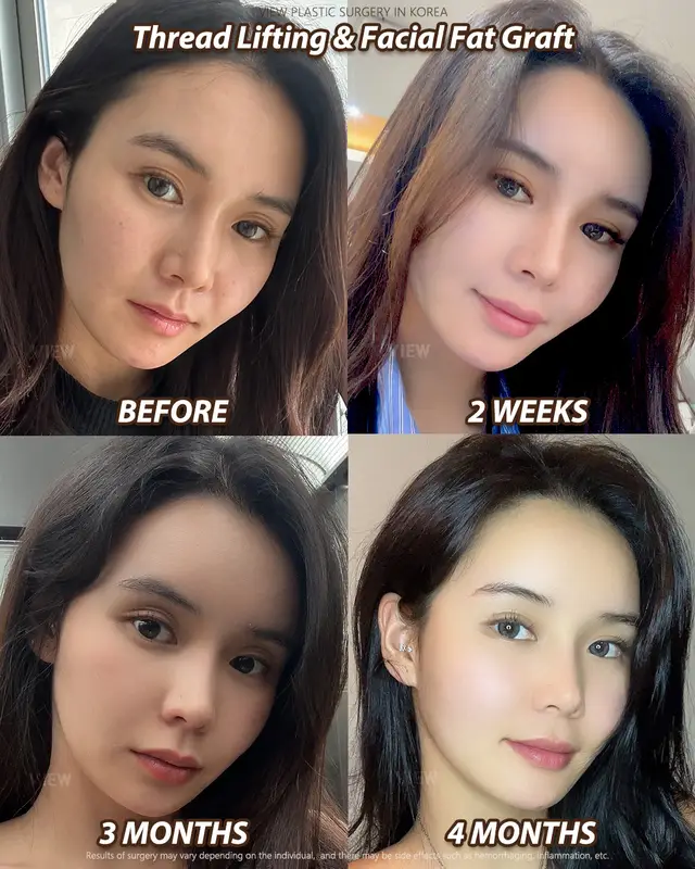 Copyrights to images and all other materials related to this content belong to View Plastic Surgery and you may be liable for unauthorized distribution and/or reproduction of the same without written consent. Results of surgery may vary depending on the individual, and there may be side effects such as haemorrhaging, inflammation, etc. #korea #glowup #kbeauty #aesthetic #beautyupgrade