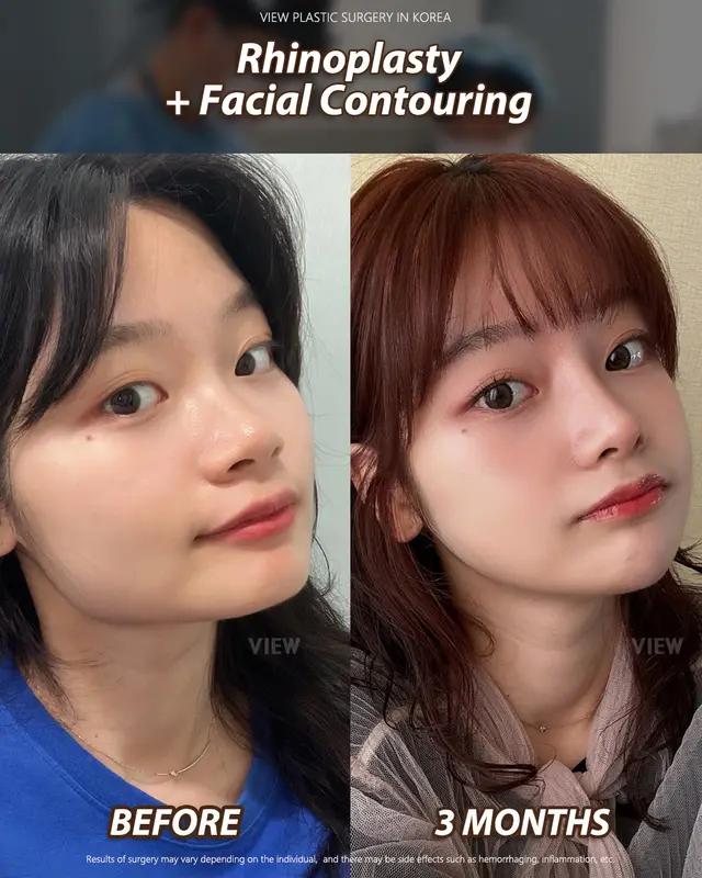 Copyrights to images and all other materials related to this content belong to View Plastic Surgery and you may be liable for unauthorized distribution and/or reproduction of the same without written consent. Results of surgery may vary depending on the individual, and there may be side effects such as haemorrhaging, inflammation, etc. #korea #glowup #kbeauty #aesthetic #beautyupgrade