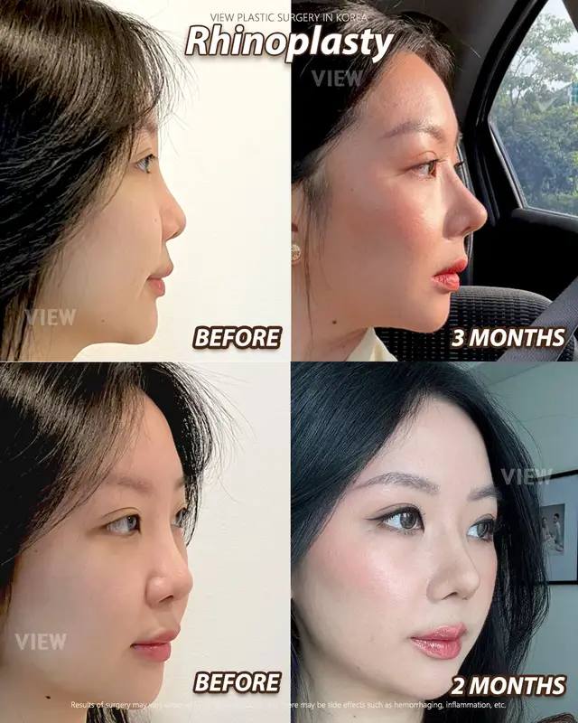 Copyrights to images and all other materials related to this content belong to View Plastic Surgery and you may be liable for unauthorized distribution and/or reproduction of the same without written consent. Results of surgery may vary depending on the individual, and there may be side effects such as haemorrhaging, inflammation, etc. #korea #glowup #kbeauty #aesthetic #beautyupgrade