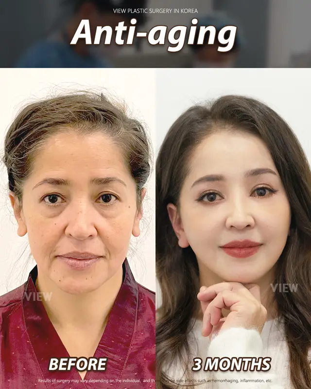 Copyrights to images and all other materials related to this content belong to View Plastic Surgery and you may be liable for unauthorized distribution and/or reproduction of the same without written consent. Results of surgery may vary depending on the individual, and there may be side effects such as haemorrhaging, inflammation, etc. #korea #glowup #kbeauty #aesthetic #beautyupgrade