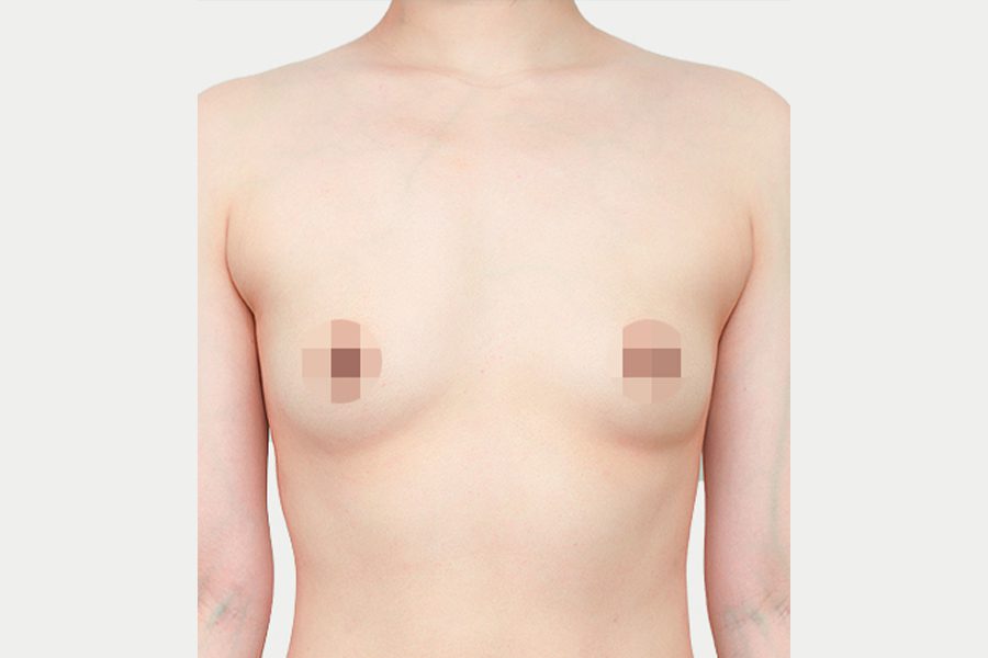 Before motiva preserve surgery