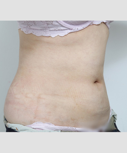 Body After