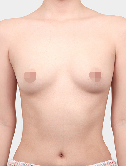 Breast Before