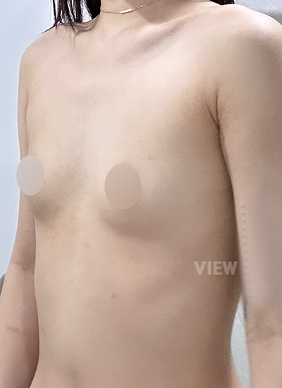 This is my consultation review for breast augmentation at View Plastic Surgery.