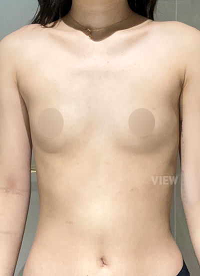 My Breast Augmentation Consultation at View Plastic Surgery, Seoul