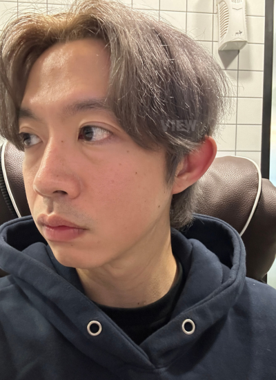 Dark circles surgery