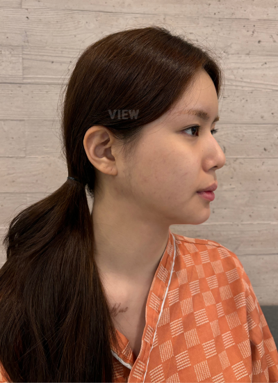 View Plastic Surgery offers 1:1 personalized consultations, every question I had about the Korean rhinoplasty technique they'd use was answered directly by the surgeon