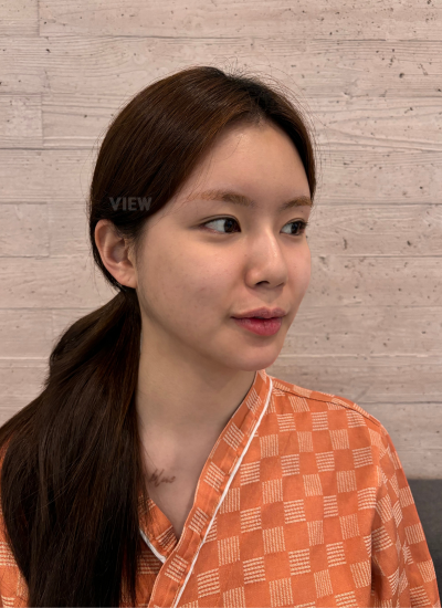 Rhinoplasty Consultation Review Before My Nose Job in Seoul