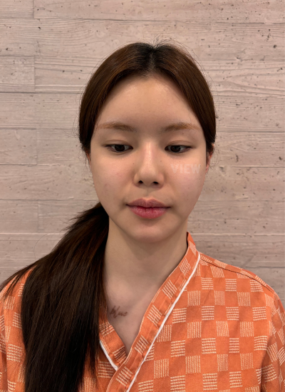 This is my consultation review before getting rhinoplasty in Korea.