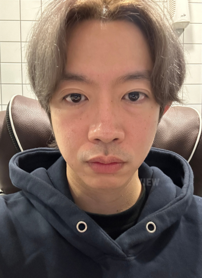 Eye Bags