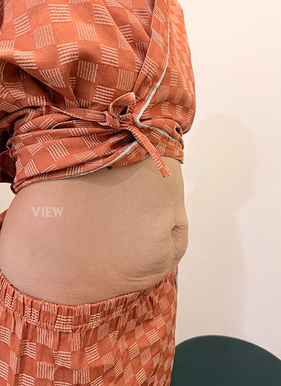 abdominoplasty in korea