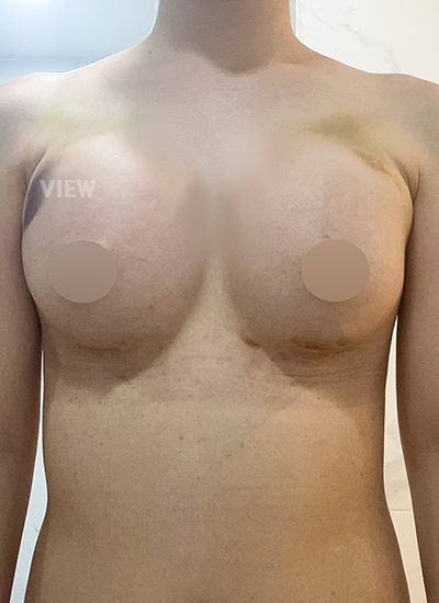 two weeks after breast surgery